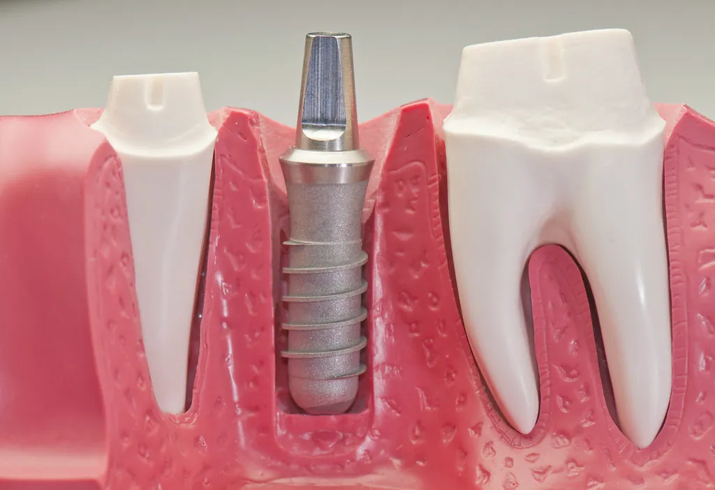 Implante dental (foto de ejemplo)